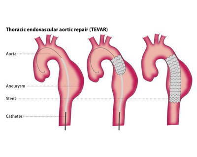 Endovascular Repair